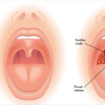 First Aid Tonsillitis